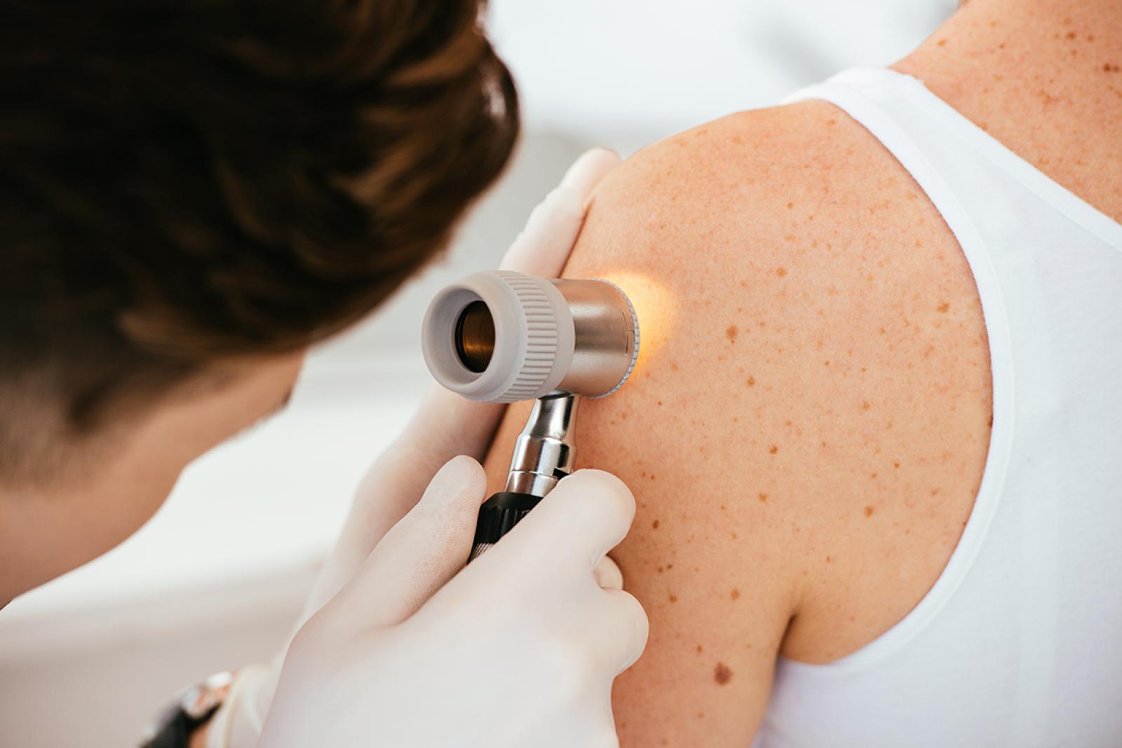 Clinician using a dermatoscope to examine moles on a patient’s shoulder