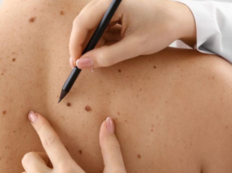 Clinician examining moles on a patient's back during a skin check